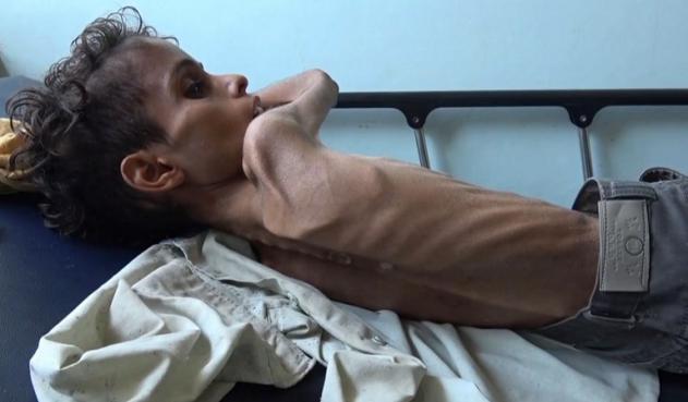 Niño Yemen hambruna