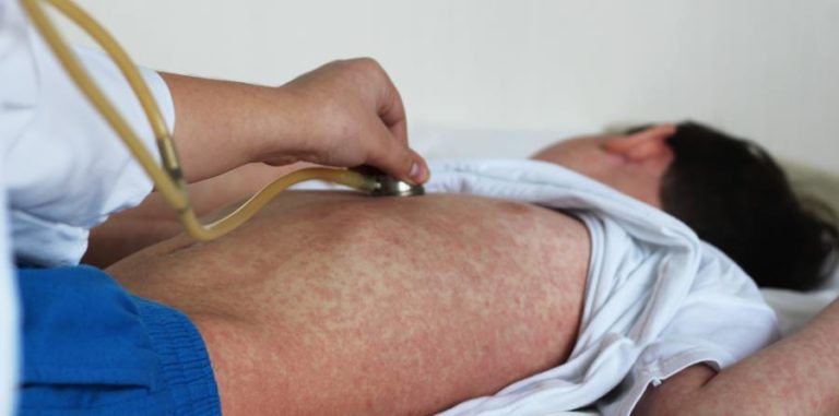 ¡25 muertos! En Samoa se agudiza epidemia de sarampión