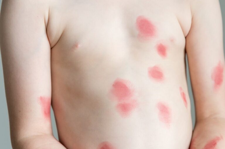 Viruela del mono detectado por primera vez en niños en EE. UU.