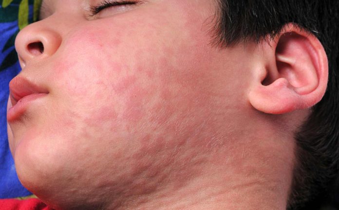 Salud Pública insta a vacunarse por brote de sarampión en SC