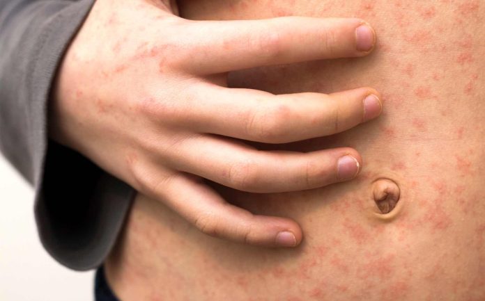 Confirmados dos nuevos casos de sarampión en Buncombe