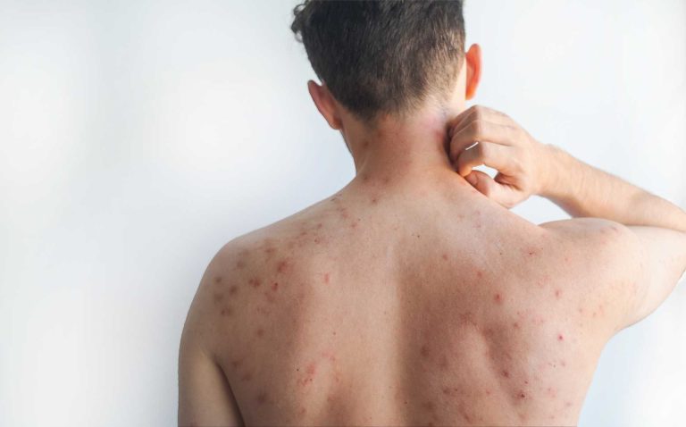 Se confirman dos casos de sarampión en Mecklenburg County