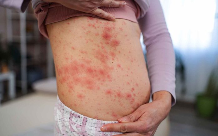 Hasta la fecha se reportan al menos 22 casos de sarampión en NC