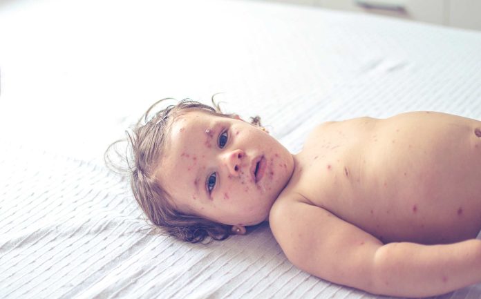 NCDHHS: Los casos de sarampión siguen aumentando