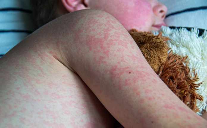 Salud Pública confirma el primer caso de sarampión en Union County