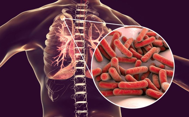 Salud Pública de Gaston County investiga la exposición a la tuberculosis